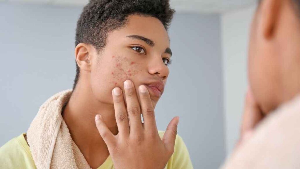 prescription acne treatments