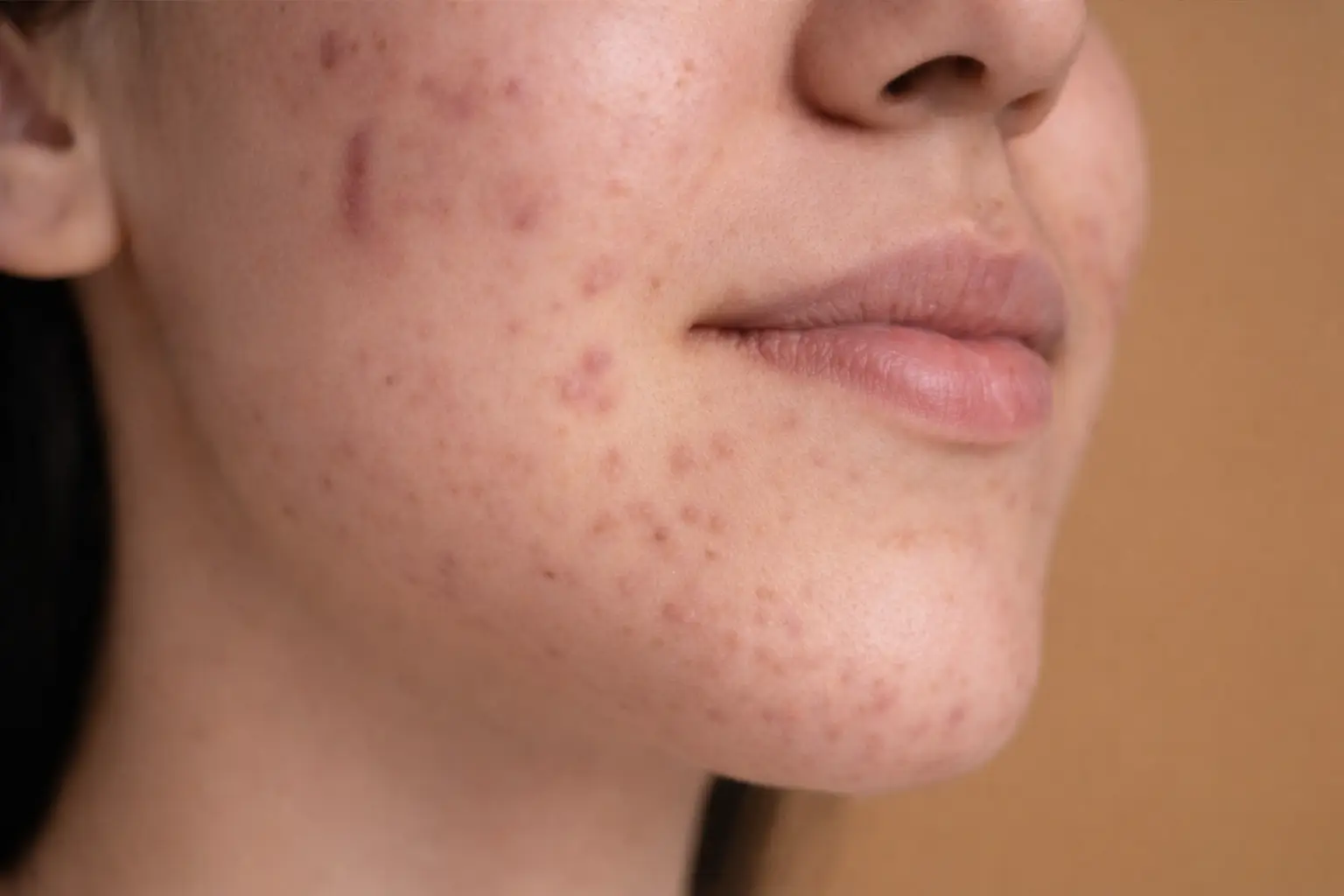Hormonal Acne in Women