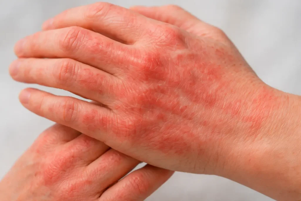 Eczema Treatments explain