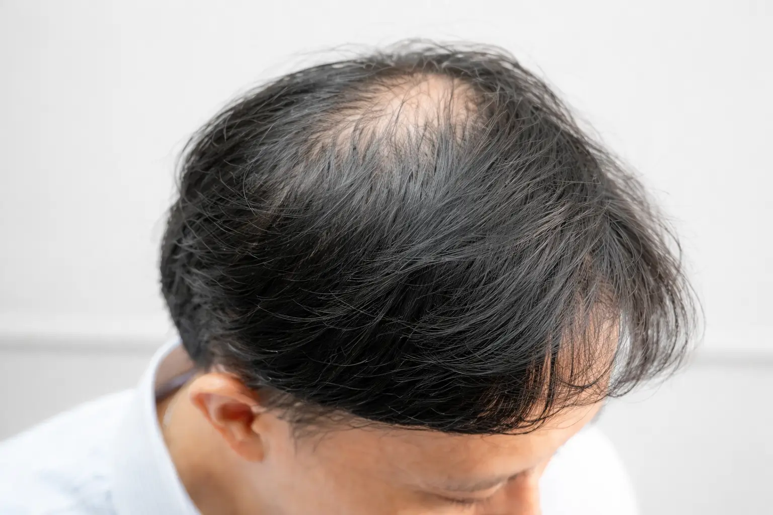 Hair Loss in Your 20