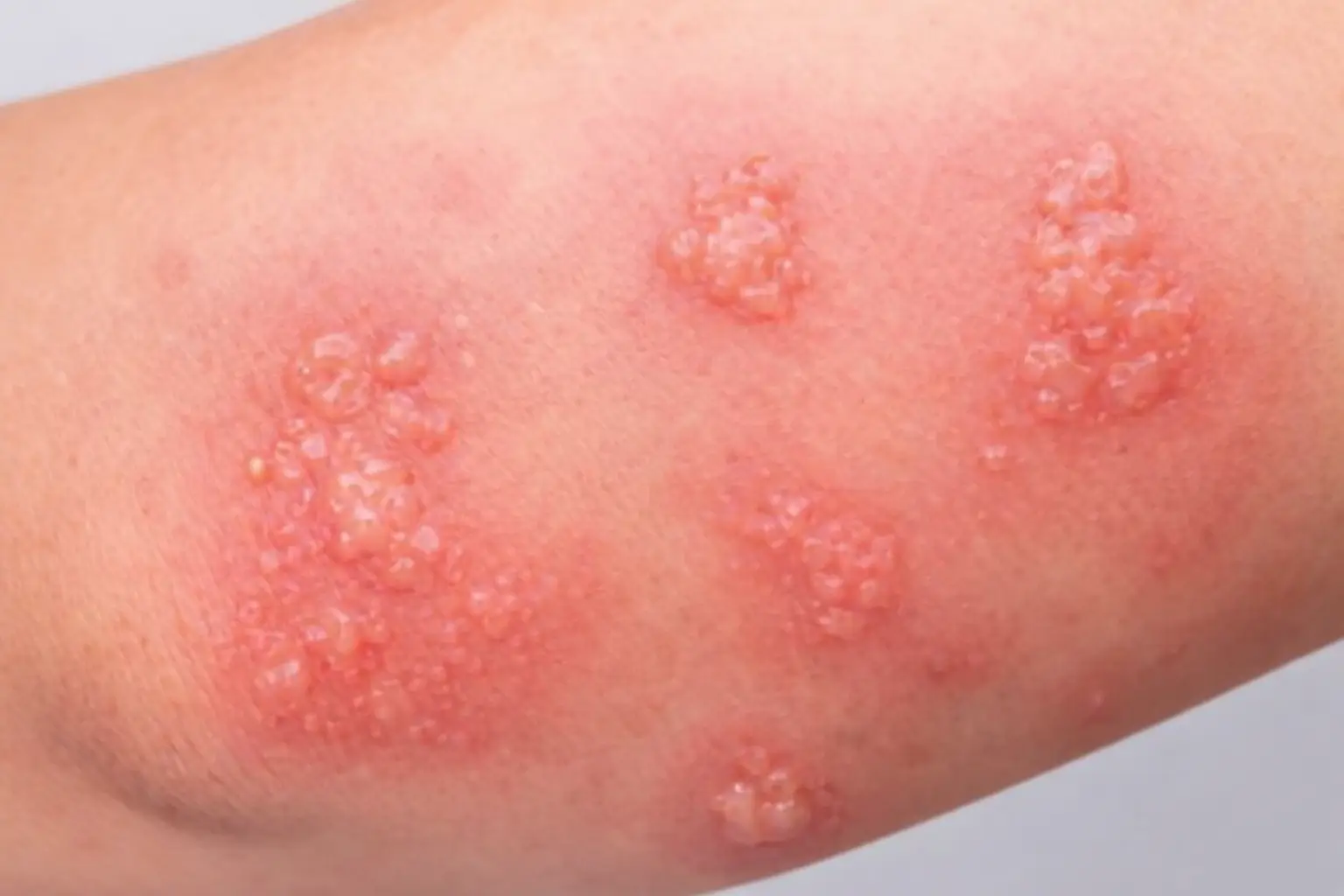how long eczema treatment takes