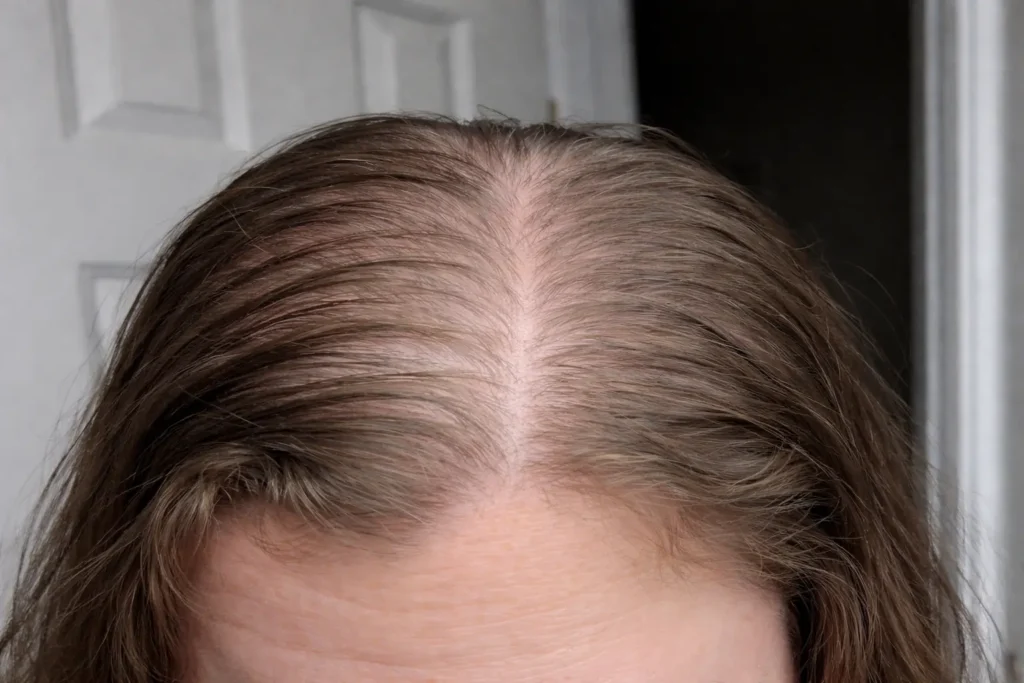 Hair Loss in Your 30s