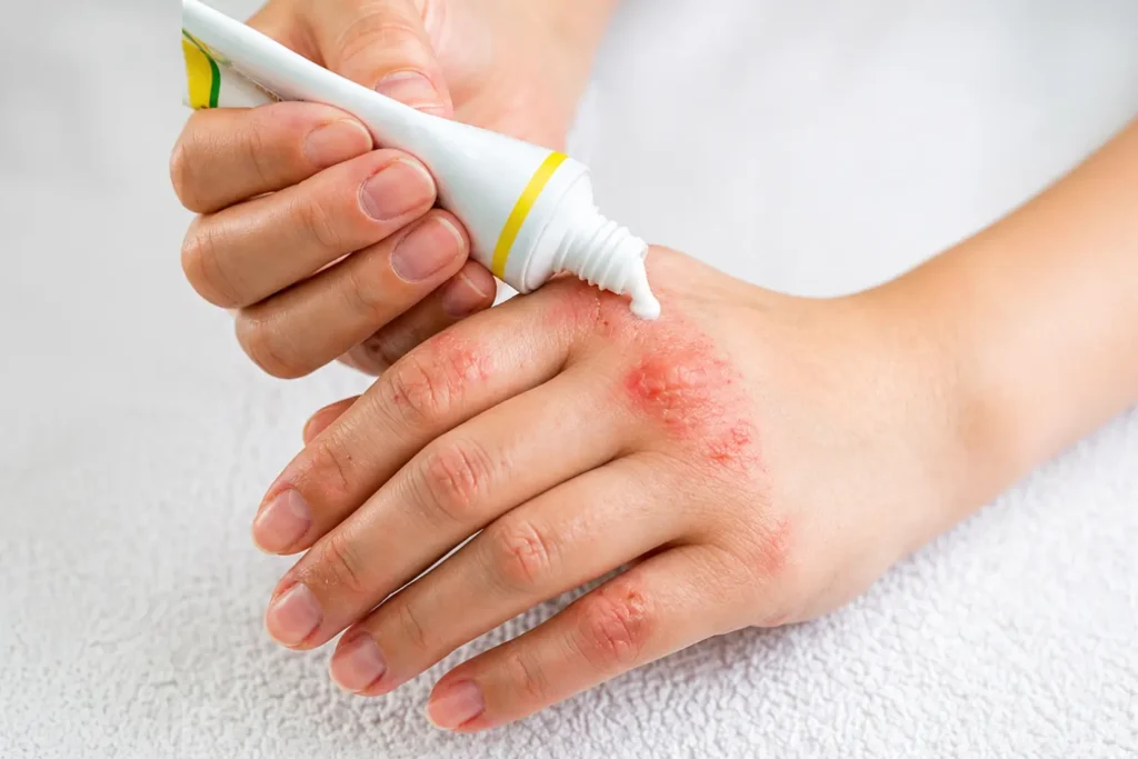 Dermatologist-Recommended Eczema Treatments