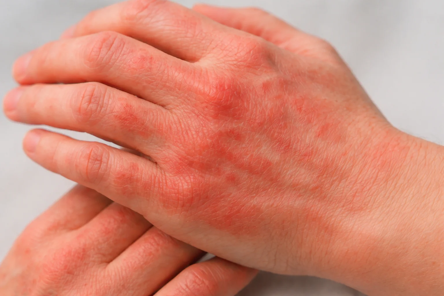 eczema treatment for face, hands, neck